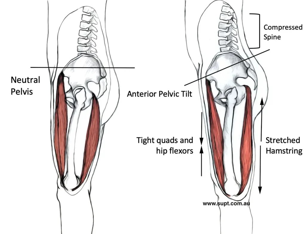 What is an ‘Anterior Pelvic Tilt’
